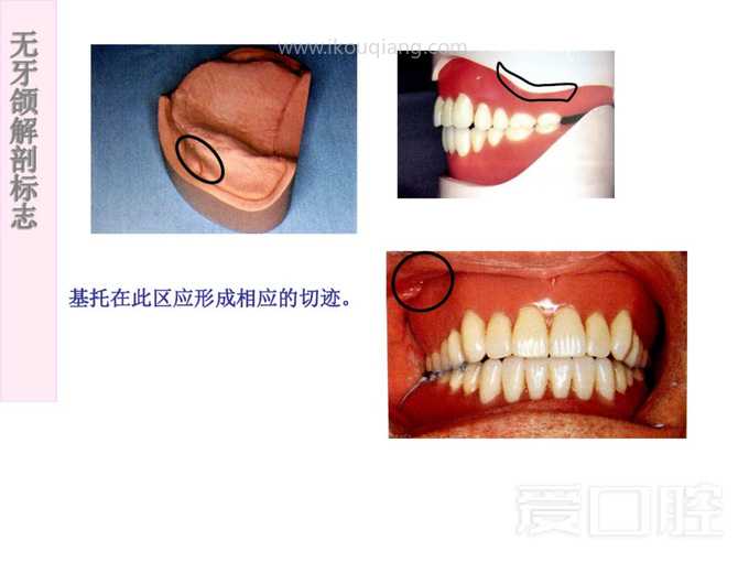 无牙颌解剖标志 5.jpg