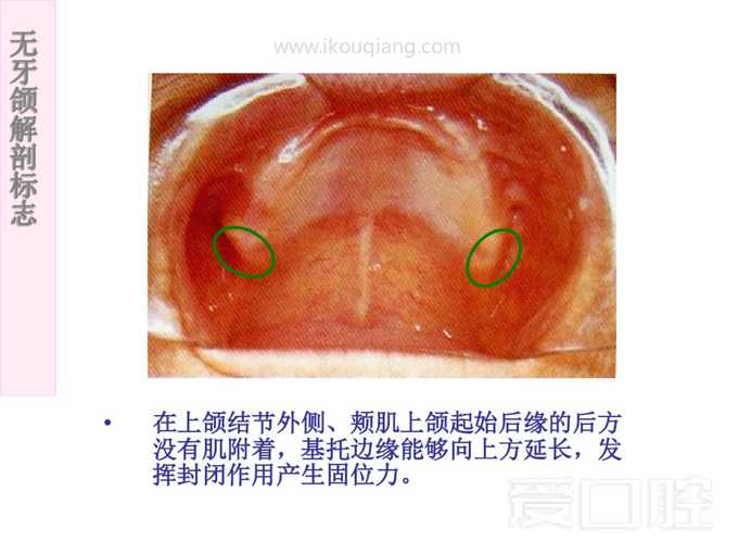 无牙颌解剖标志 10.jpg