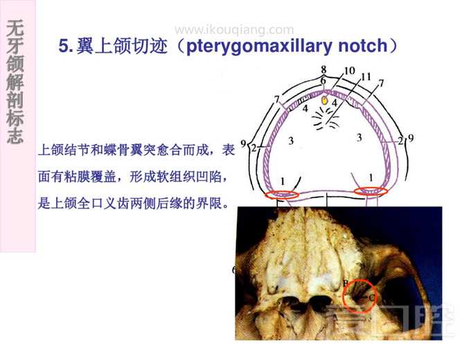 无牙颌解剖标志 12.jpg