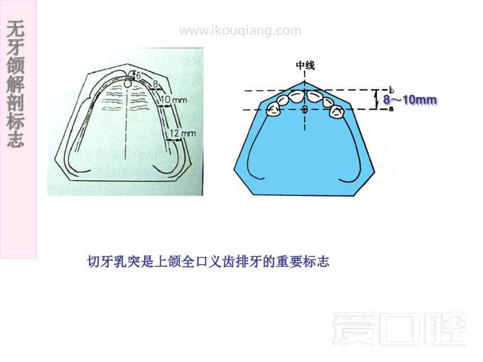 无牙颌解剖标志 15.jpg