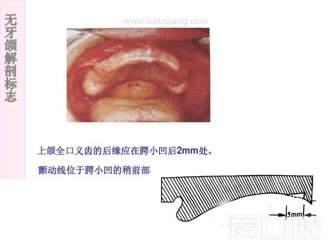 无牙颌解剖标志 20.jpg