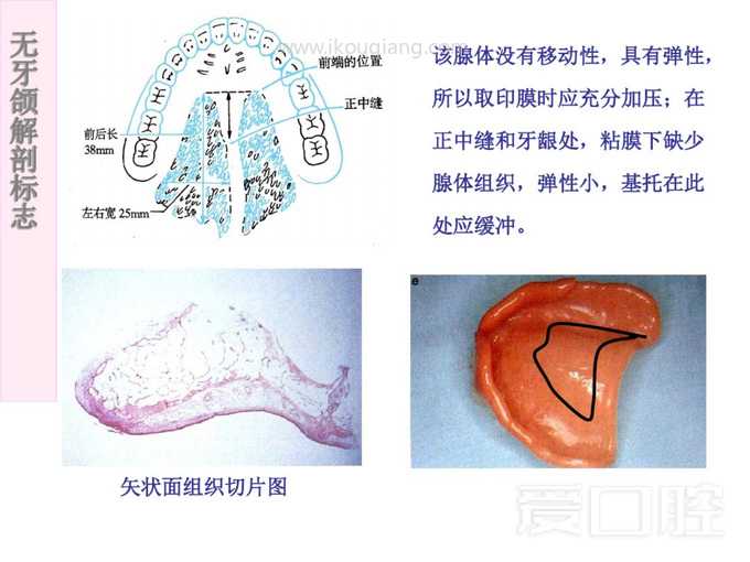 无牙颌解剖标志 22.jpg