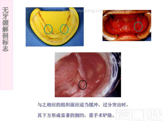 无牙颌解剖标志 38.jpg