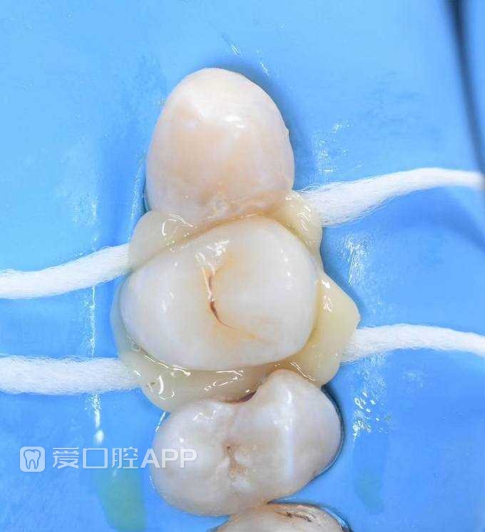 看个根充覆盖嵌体修复上颌第一前磨牙