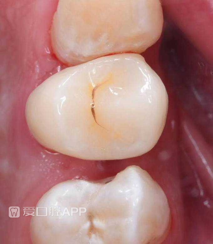 看个根充覆盖嵌体修复上颌第一前磨牙