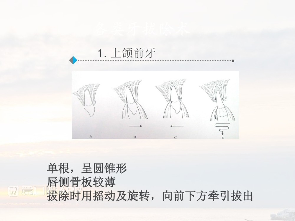 拔牙器械及操作详解_33.jpg