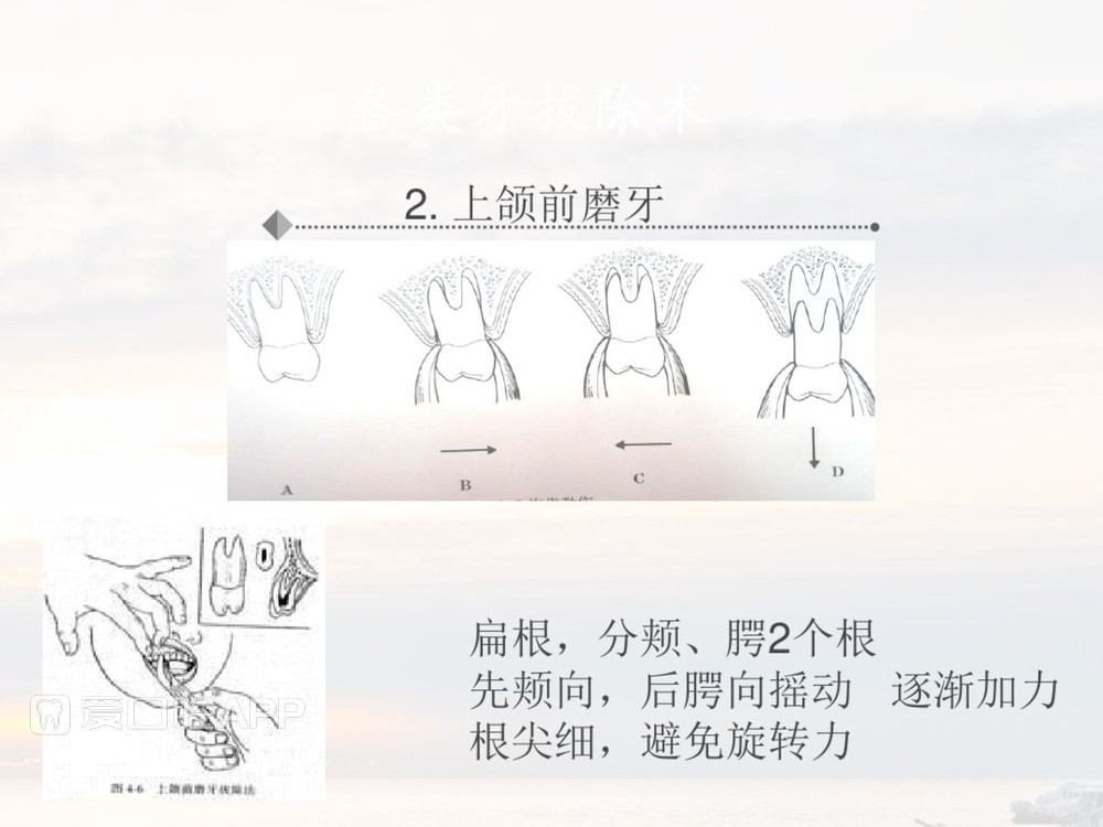 拔牙器械及操作详解_34.jpg