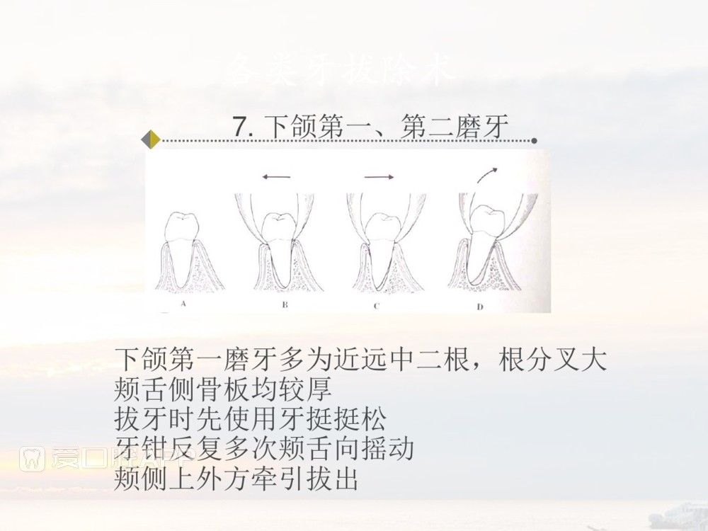 拔牙器械及操作详解_39.jpg