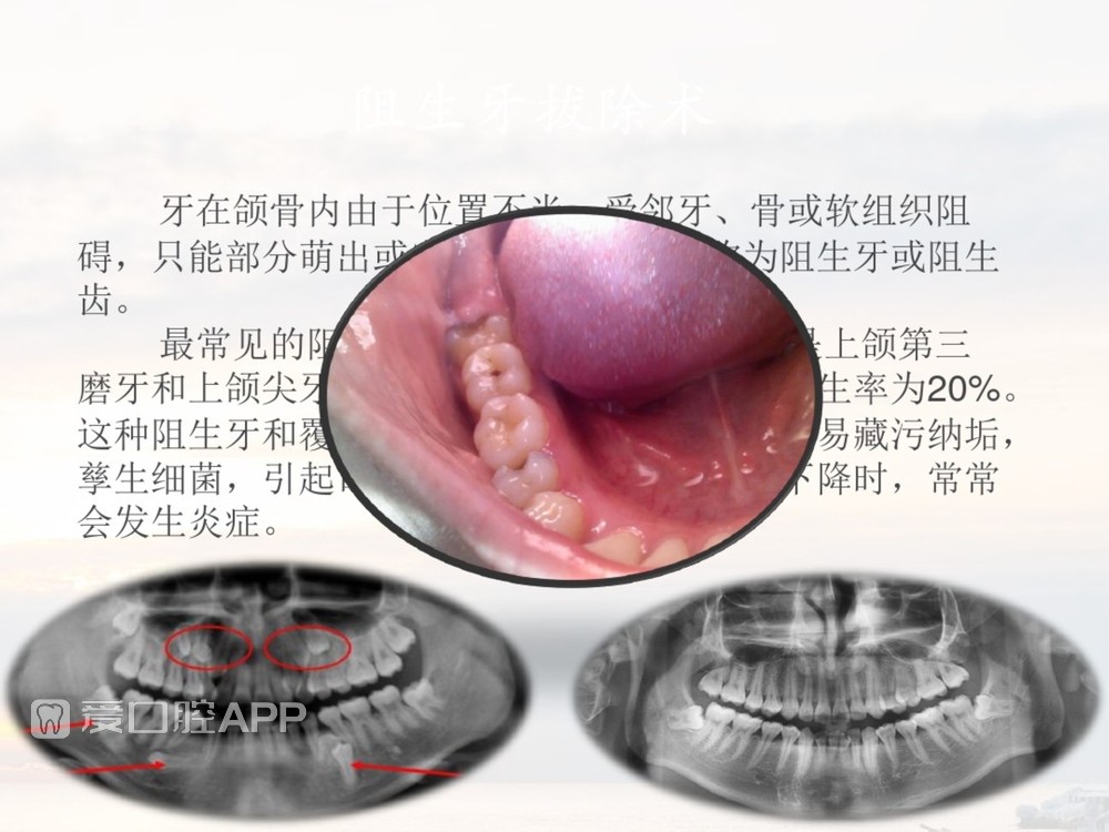 拔牙器械及操作详解_42.jpg