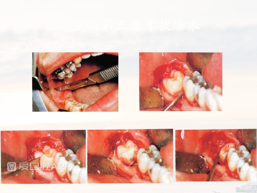 拔牙器械及操作详解_53.jpg