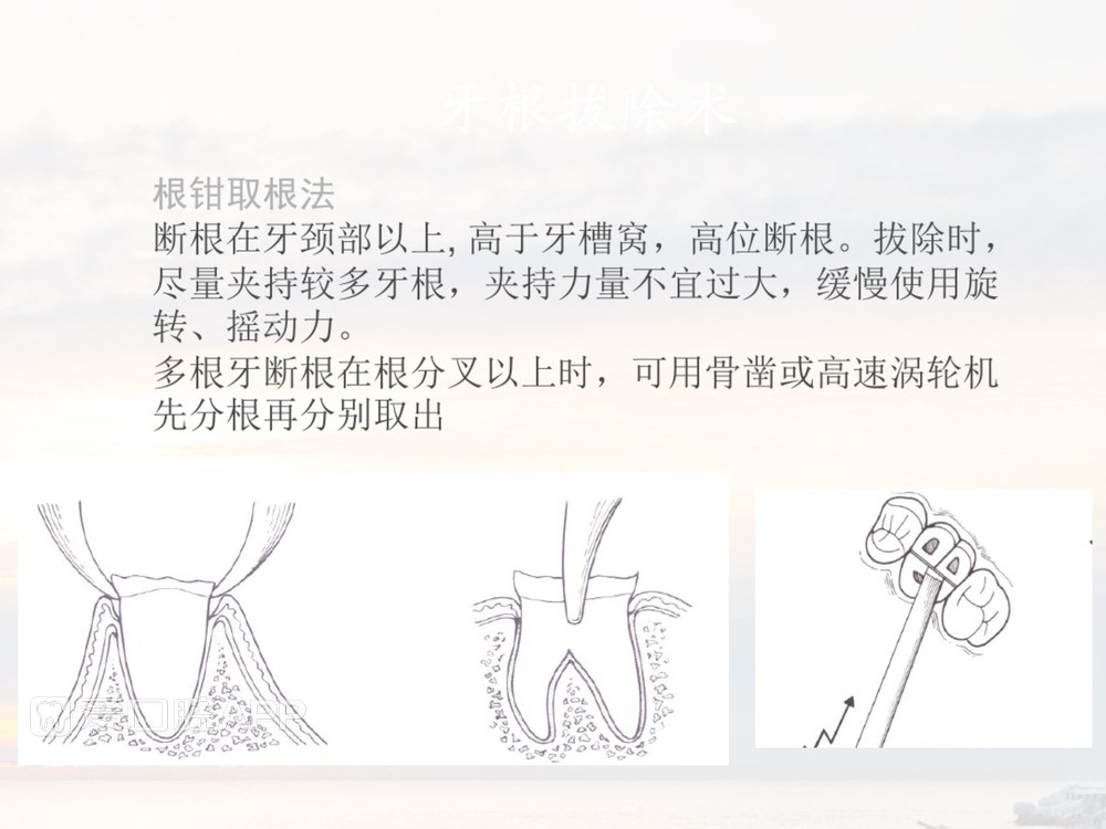 拔牙器械及操作详解_55.jpg