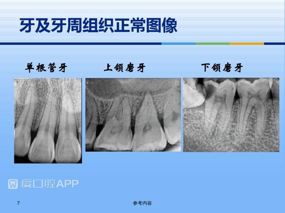 牙体牙周正常解剖及常见病X线表现(内容丰富)_7.jpg