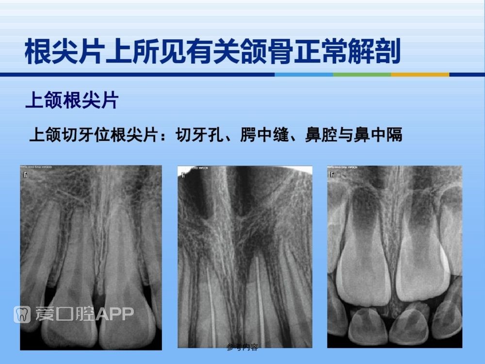 牙体牙周正常解剖及常见病X线表现(内容丰富)_10.jpg