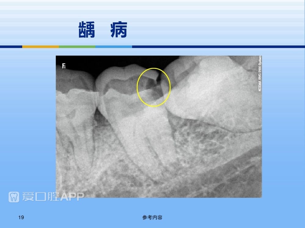 牙体牙周正常解剖及常见病X线表现(内容丰富)_19.jpg