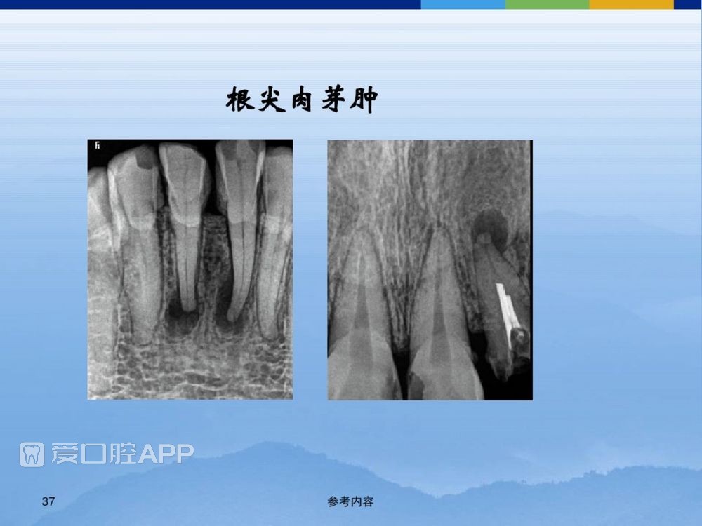 牙体牙周正常解剖及常见病X线表现(内容丰富)_37.jpg