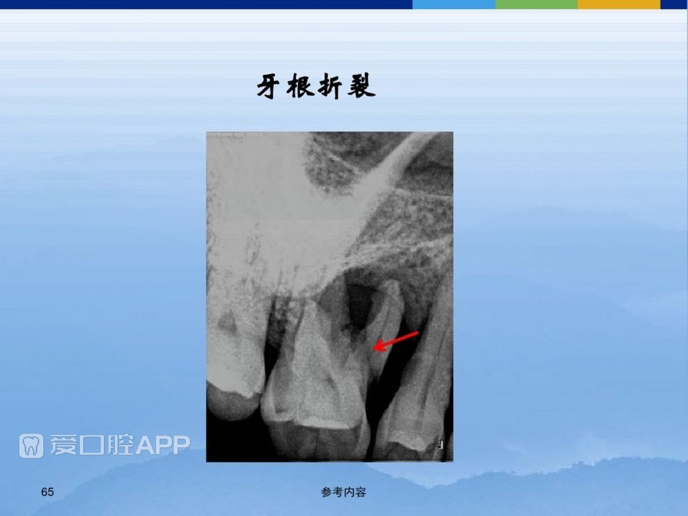 牙体牙周正常解剖及常见病X线表现(内容丰富)_65.jpg