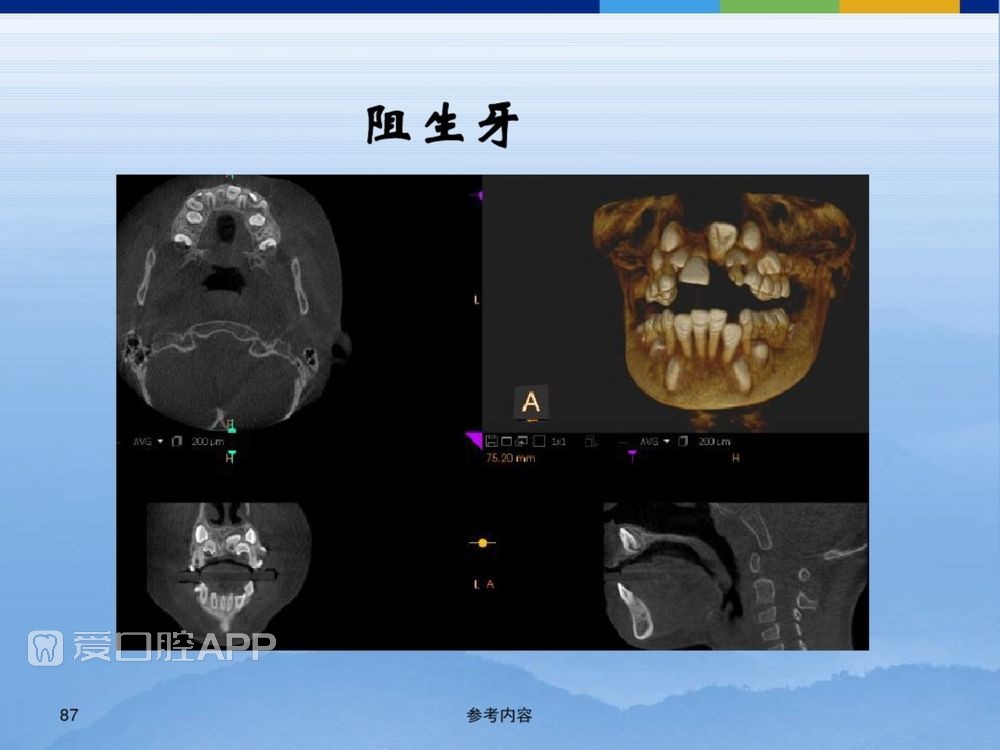 牙体牙周正常解剖及常见病X线表现(内容丰富)_87.jpg