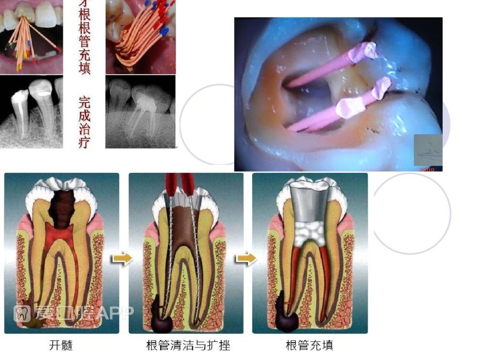 口腔科常用器械图谱、结构及功能介绍_23.jpg