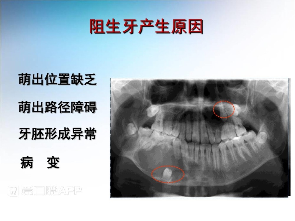 阻生牙拔除术(课堂PPT)_9.jpg