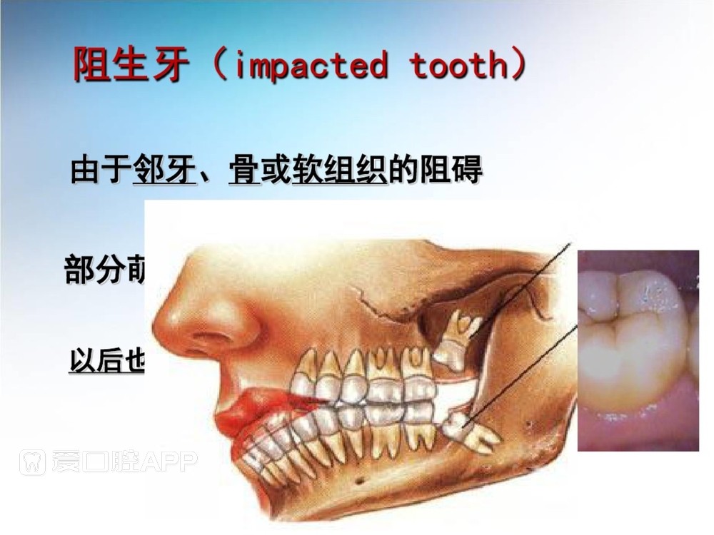 阻生牙拔除术(课堂PPT)_5.jpg