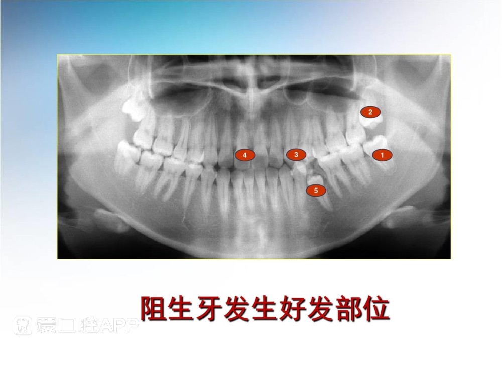 阻生牙拔除术(课堂PPT)_7.jpg