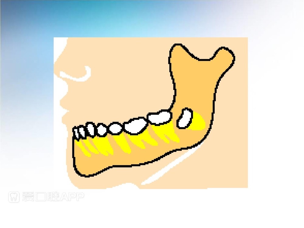 阻生牙拔除术(课堂PPT)_6.jpg