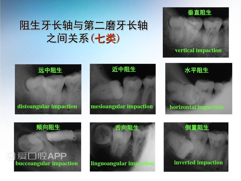 阻生牙拔除术(课堂PPT)_11.jpg