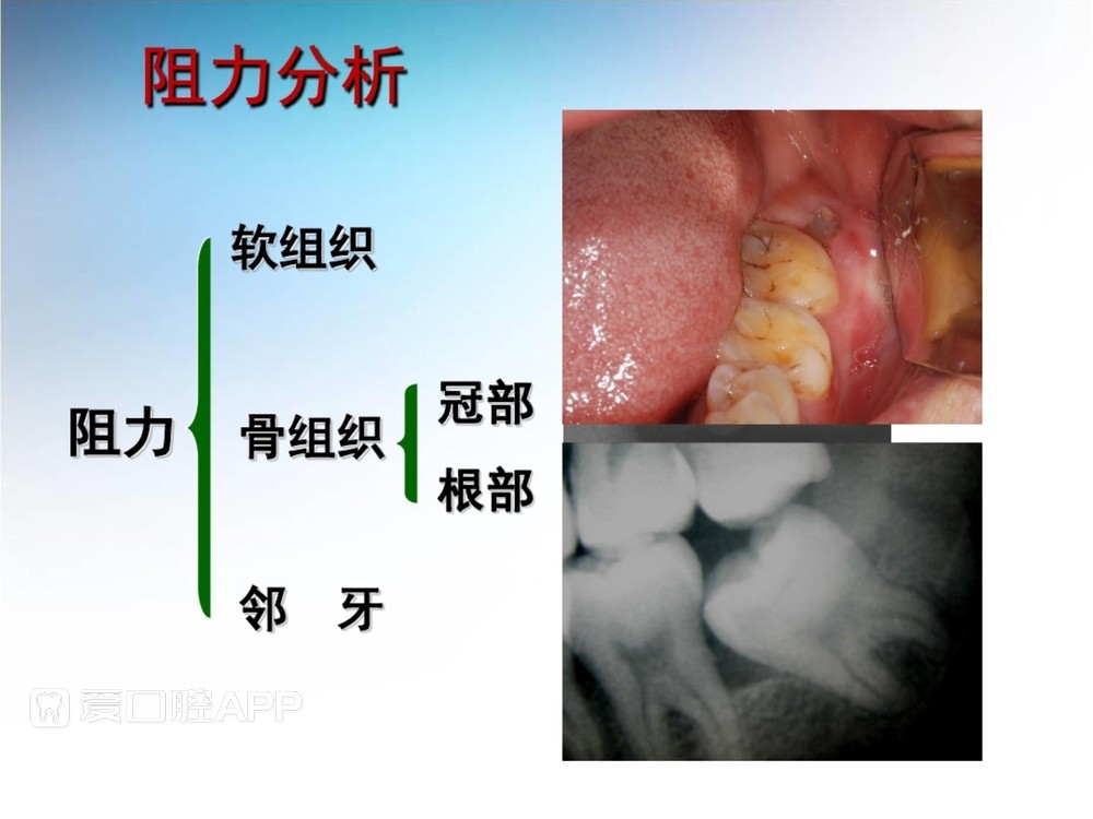 阻生牙拔除术(课堂PPT)_19.jpg