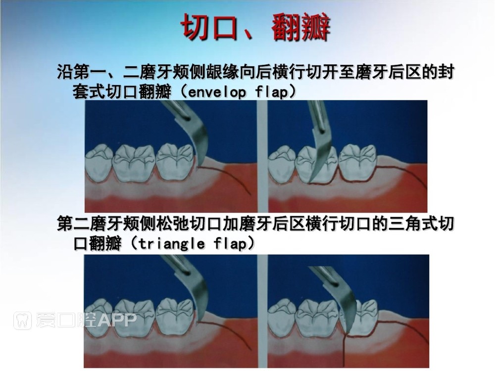 阻生牙拔除术(课堂PPT)_22.jpg