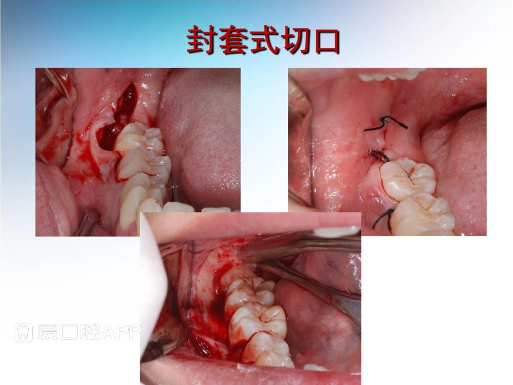 阻生牙拔除术(课堂PPT)_23.jpg