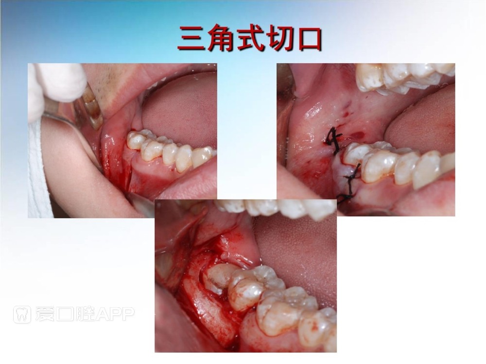 阻生牙拔除术(课堂PPT)_24.jpg