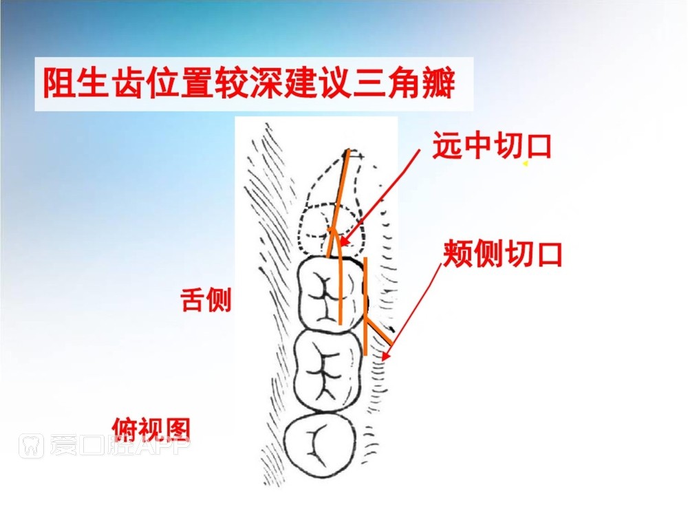 阻生牙拔除术(课堂PPT)_25.jpg