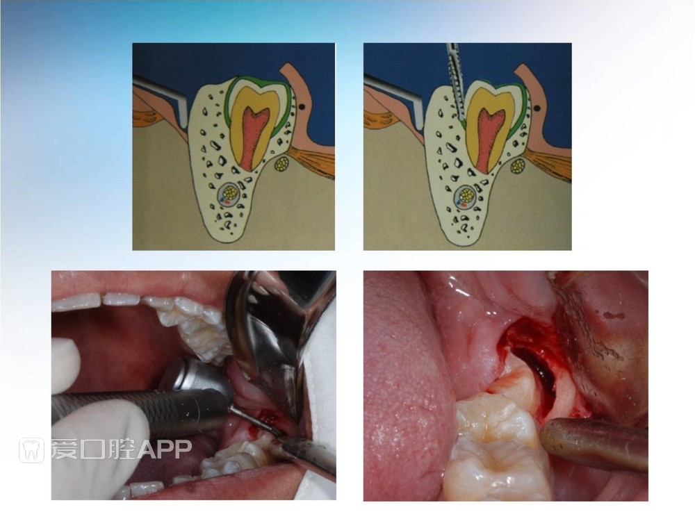 阻生牙拔除术(课堂PPT)_28.jpg