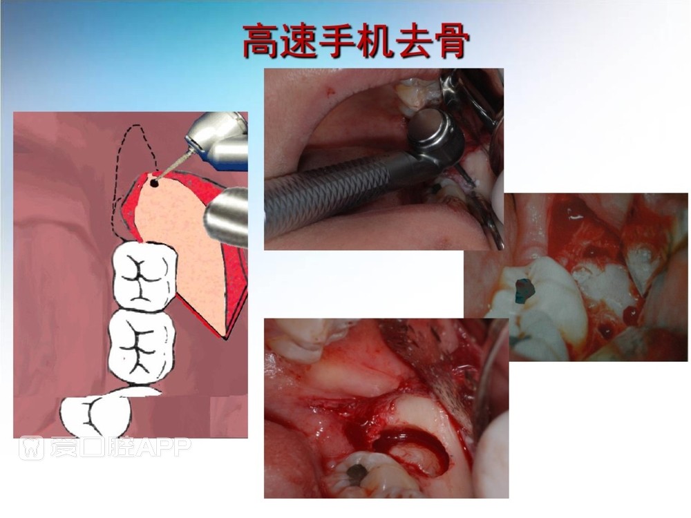 阻生牙拔除术(课堂PPT)_27.jpg