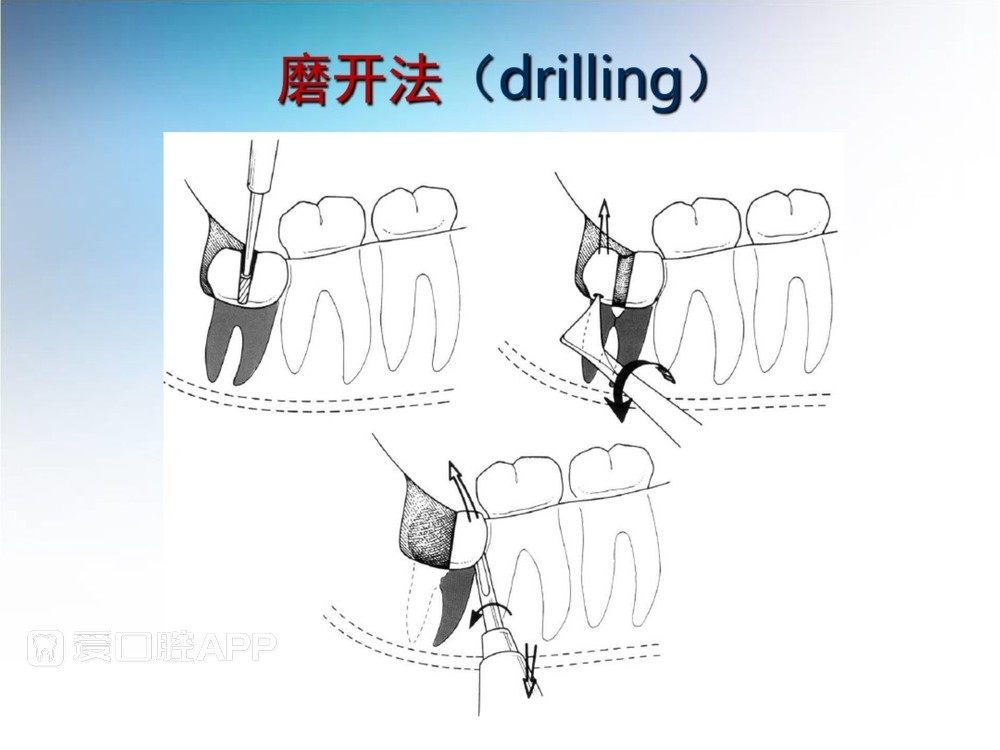 阻生牙拔除术(课堂PPT)_32.jpg