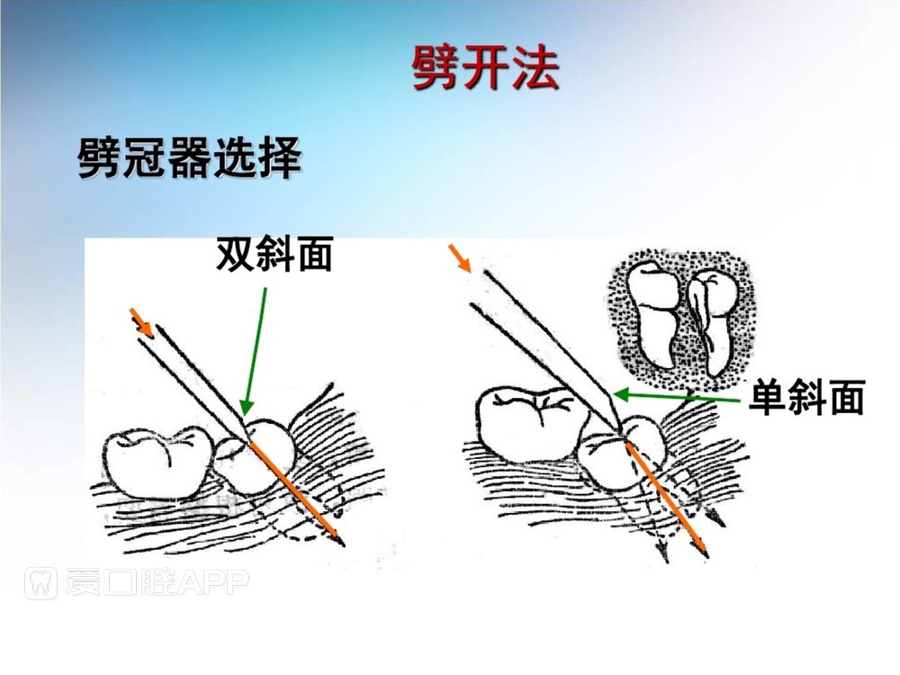 阻生牙拔除术(课堂PPT)_36.jpg