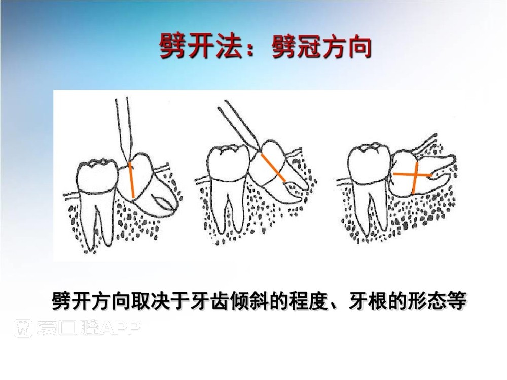 阻生牙拔除术(课堂PPT)_37.jpg