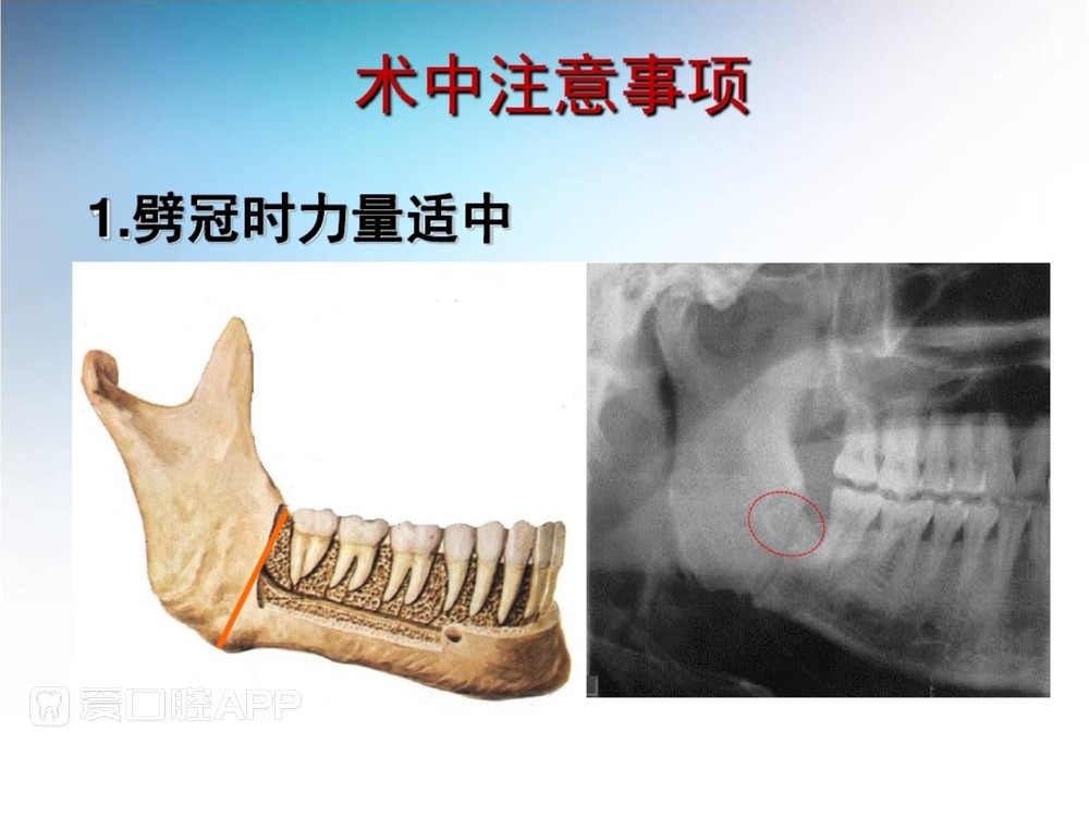 阻生牙拔除术(课堂PPT)_39.jpg