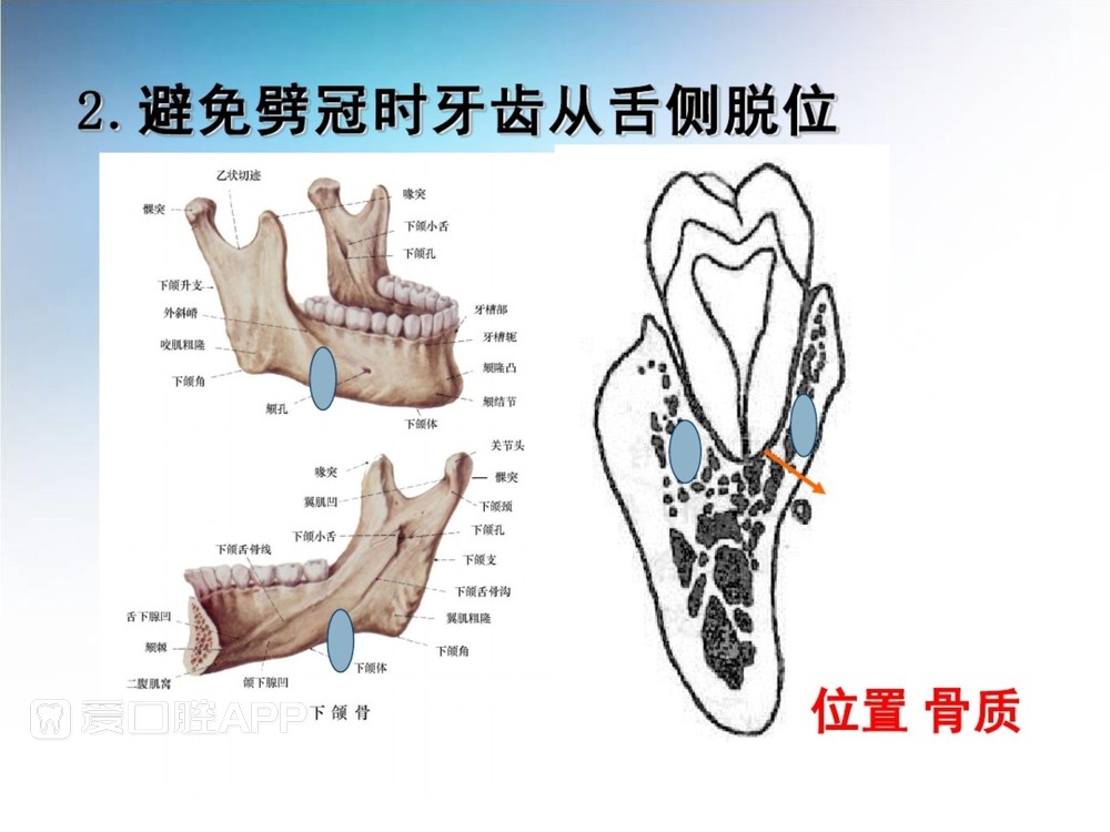 阻生牙拔除术(课堂PPT)_40.jpg