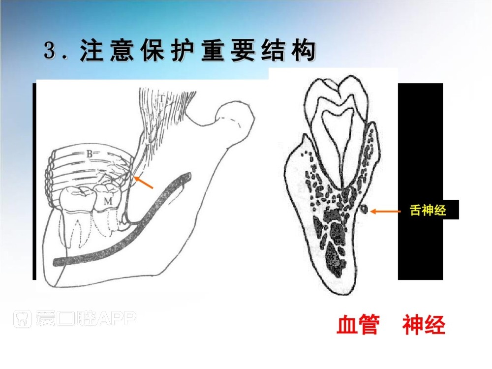 阻生牙拔除术(课堂PPT)_41.jpg